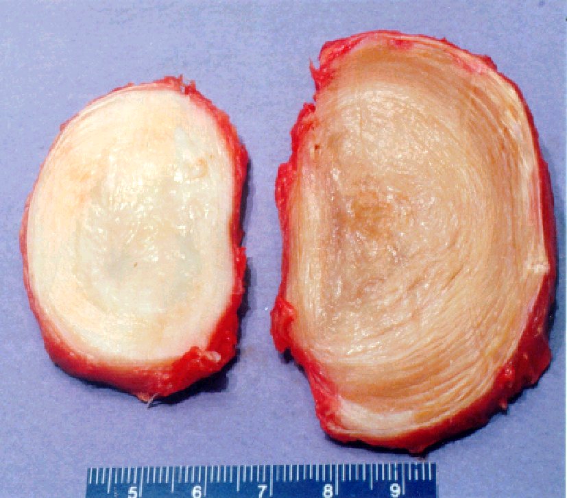 EPITROCHOID_LEFT_NORMAL_RIGHT_DEGENERATIVE_HUMAN_INTERVERTEBRAL_STRUCTURE7B.jpg (113536 bytes)