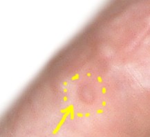 EGG_SHELL_IN_SKIN3_REMOVED.jpg (7419 bytes)