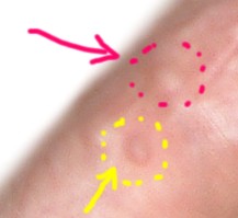 EGG_SHELL_IN_SKIN4_REMOVED.jpg (8769 bytes)