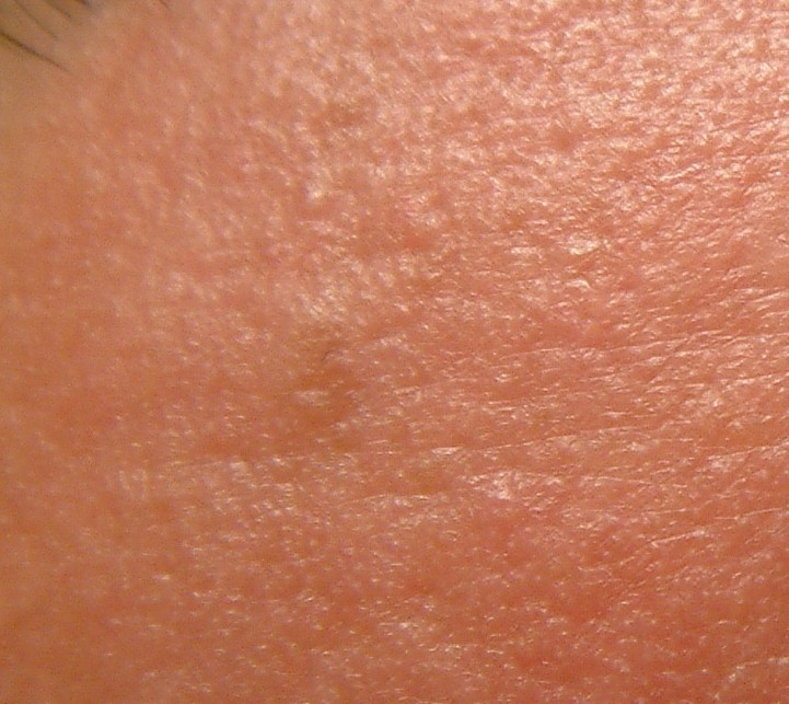EGG_SHELL_IN_SKIN_FOREHEAD_LEFT.jpg (117333 bytes)
