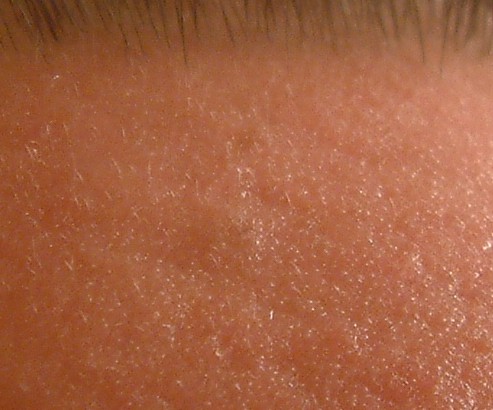 EGG_SHELL_IN_SKIN_FOREHEAD_LEFT1.jpg (50225 bytes)