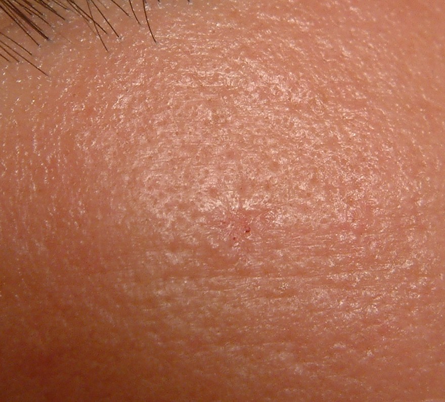 EGG_SHELL_IN_SKIN_FOREHEAD_LEFT11.jpg (66652 bytes)