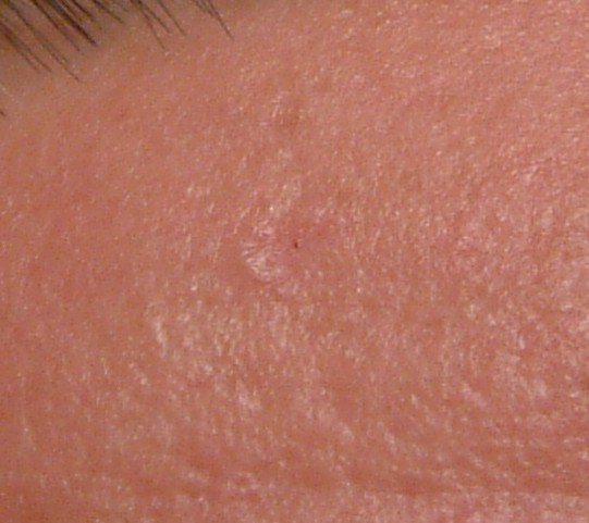 EGG_SHELL_IN_SKIN_FOREHEAD_LEFT12.jpg (66652 bytes)