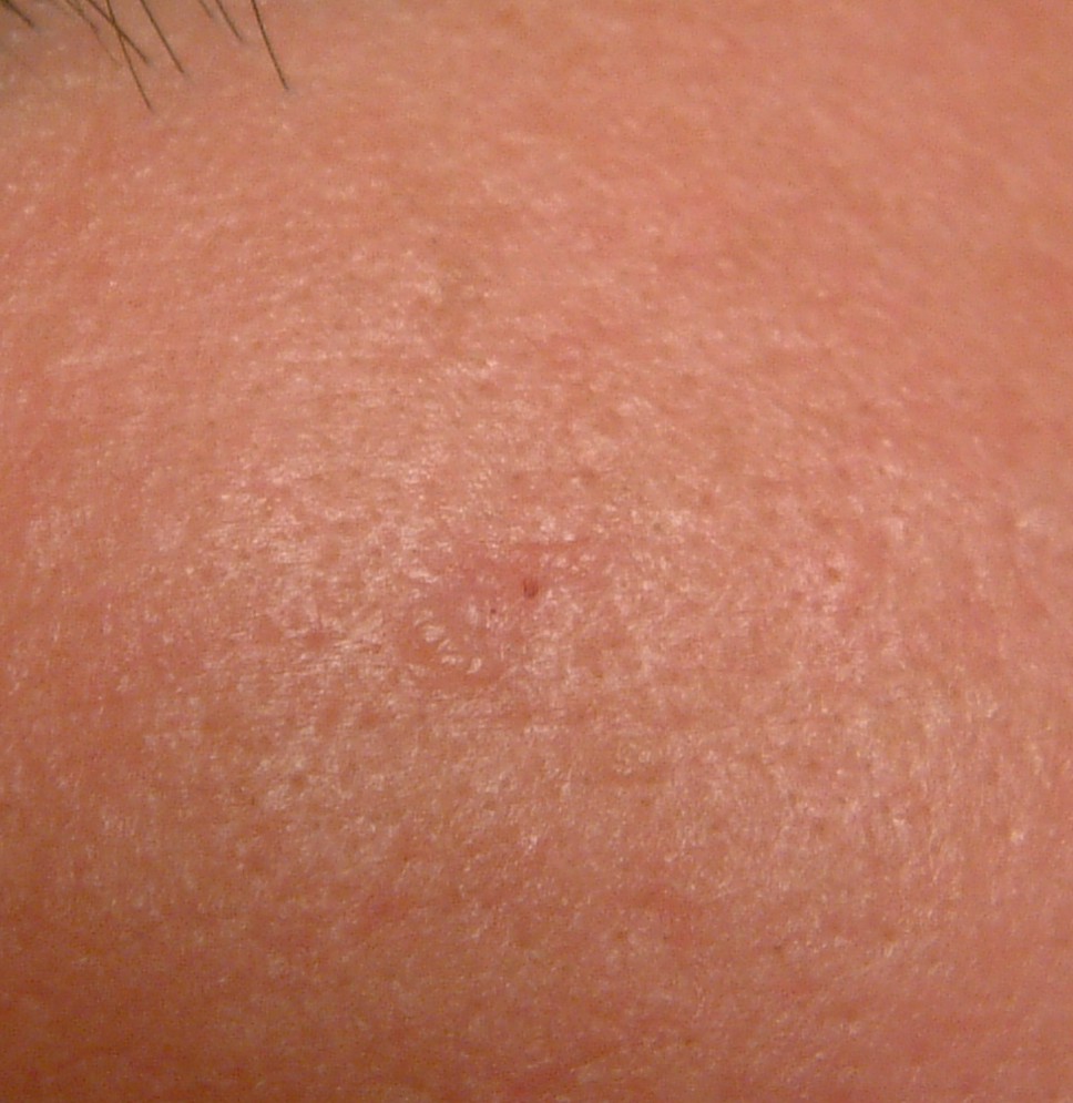 EGG_SHELL_IN_SKIN_FOREHEAD_LEFT13.jpg (66652 bytes)