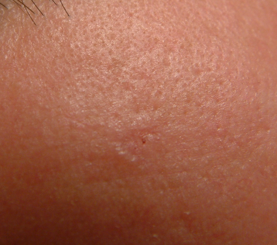 EGG_SHELL_IN_SKIN_FOREHEAD_LEFT14.jpg (66652 bytes)