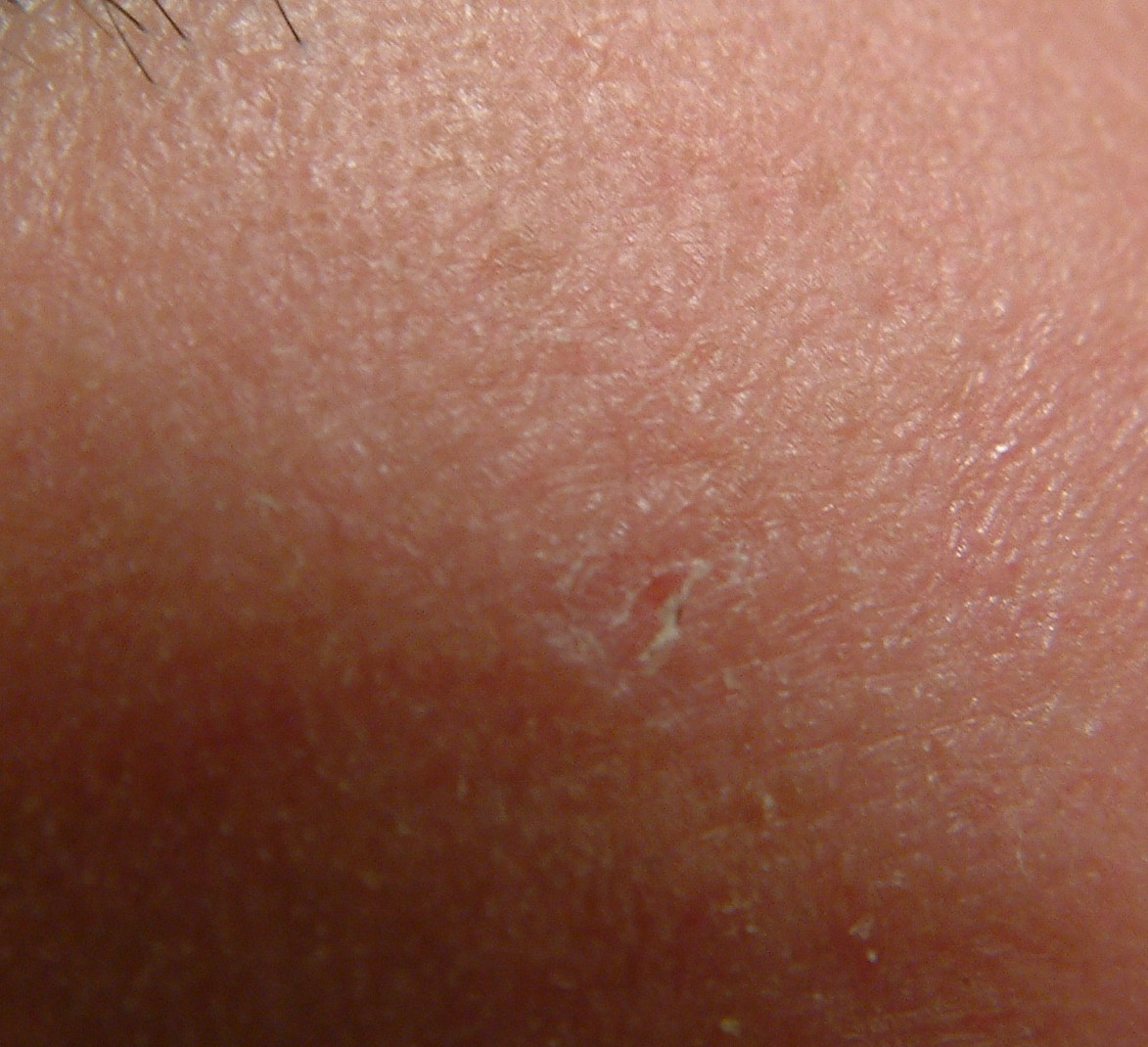 EGG_SHELL_IN_SKIN_FOREHEAD_LEFT15.jpg (66652 bytes)