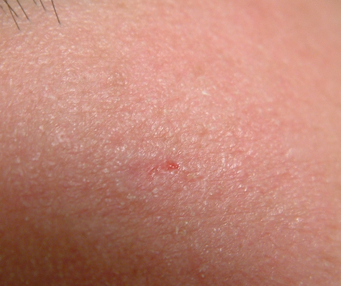 EGG_SHELL_IN_SKIN_FOREHEAD_LEFT16.jpg (66652 bytes)