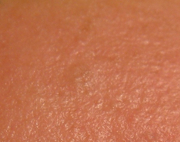 EGG_SHELL_IN_SKIN_FOREHEAD_LEFT3.jpg (66652 bytes)
