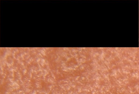 EGG_SHELL_IN_SKIN_FOREHEAD_LEFT4.jpg (66652 bytes)