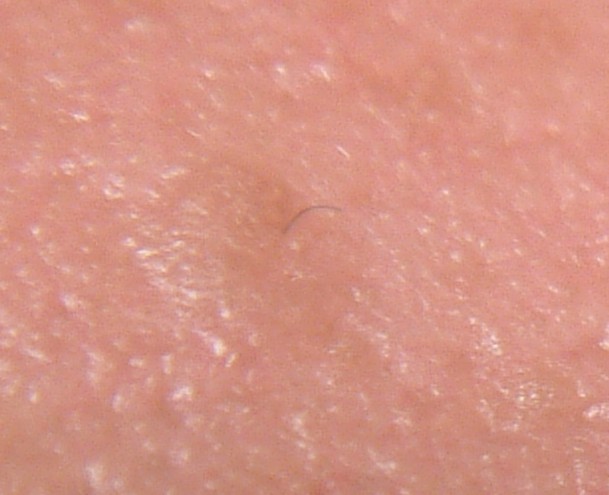 EGG_SHELL_IN_SKIN_FOREHEAD_LEFT5.jpg (66652 bytes)