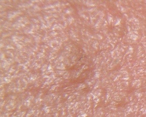 EGG_SHELL_IN_SKIN_FOREHEAD_LEFT6.jpg (66652 bytes)