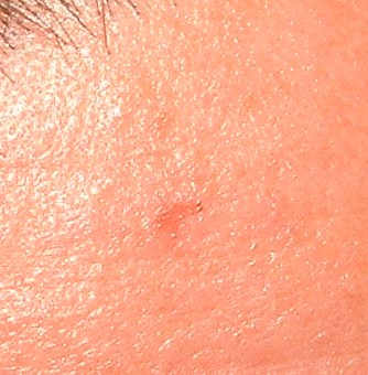 EGG_SHELL_IN_SKIN_FOREHEAD_LEFT7.jpg (66652 bytes)