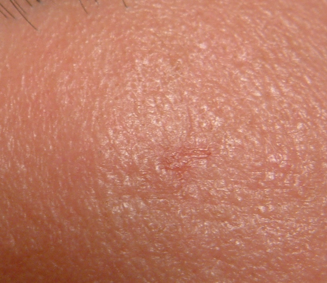 EGG_SHELL_IN_SKIN_FOREHEAD_LEFT8.jpg (66652 bytes)