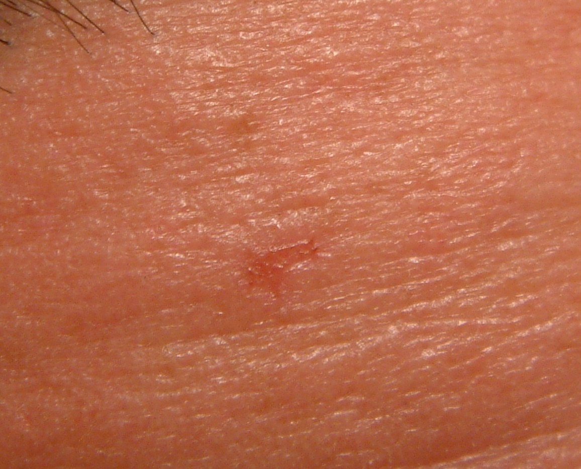 EGG_SHELL_IN_SKIN_FOREHEAD_LEFT10.jpg (66652 bytes)